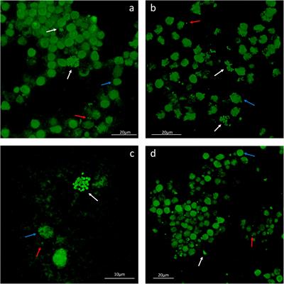 Identification and Characterization of Planktonic Biofilm-Like Aggregates in Infected Synovial Fluids From Joint Infections